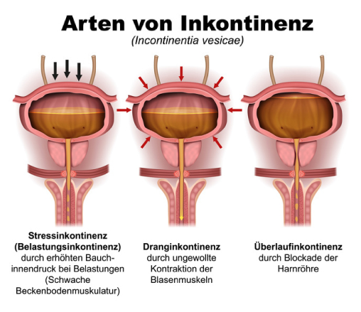 Inkontinenz ärztliche Behandlung in der Praxis Eidler Urologie Tulln